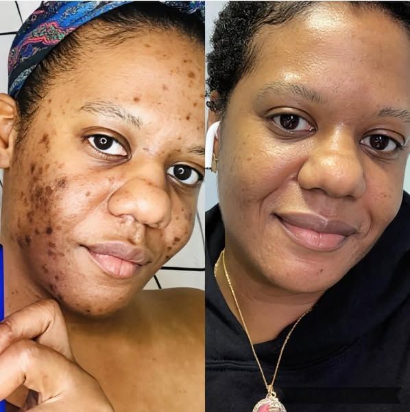 Fatimah — before and after 2 weeks