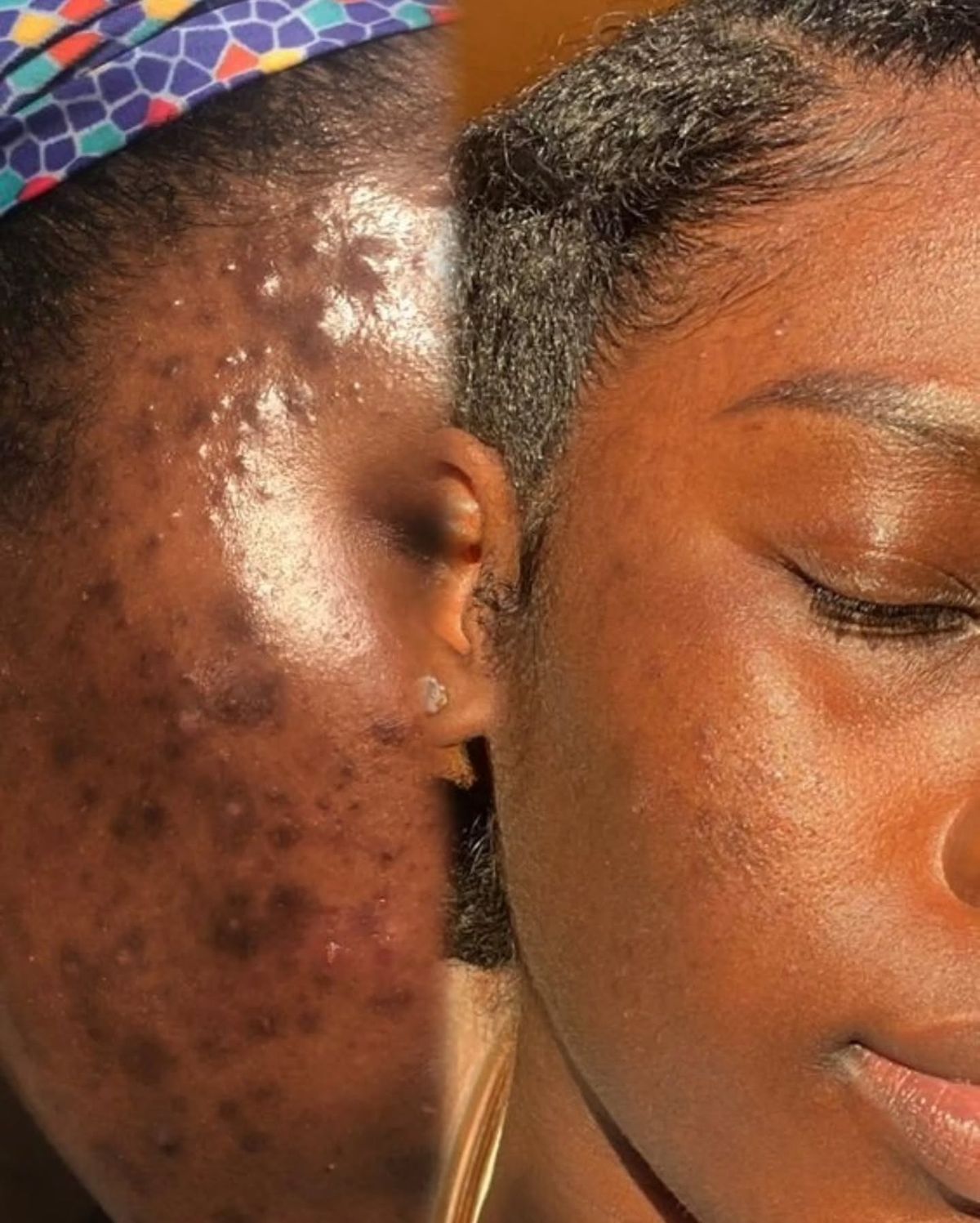Bimpe — before and after 5 weeks
