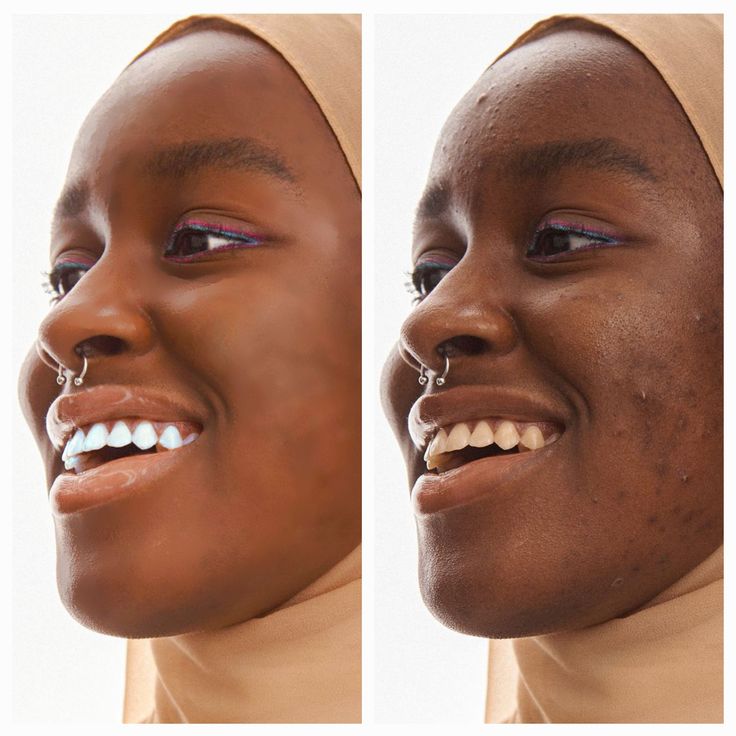 Amira — before and after 7 weeks
